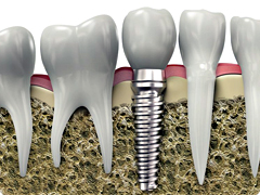 ���ö�Ʈ ����